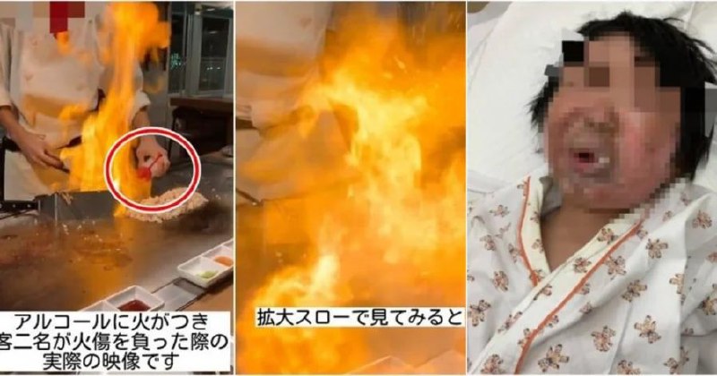 铁板烧师傅“喷火秀”出事　日本5岁男童半脸烧黑脱皮